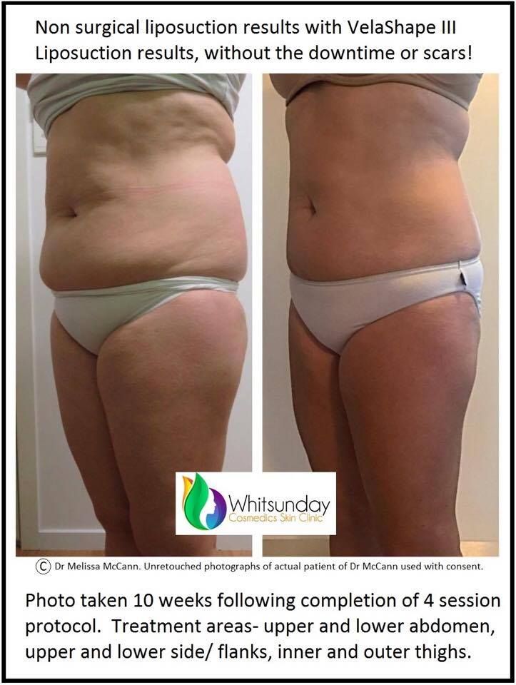 Face & Body Contouring, Skin Tightening and Cellulite Reduction - Hyaface